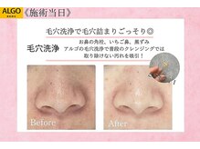 アルゴ 豊中岡町駅前店(ALGO)/【毛穴洗浄+光脱毛】