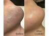 【男性人気No.1】効果重視!ヒゲ脱毛 ¥4,500