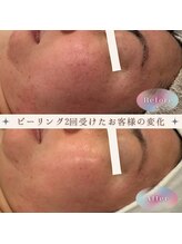 チアフル 鶴見店(Cheerful)/たったの2回でこの変化◎