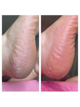 ベル(Belle)/足裏角質ケア