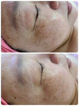 ケンビラク(Kenbiraku 健美楽)/ハイドラ　プラズマ　RF　美容液