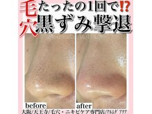 アルムダアクア 天王寺店(Aleumda AQUA)/毛穴エクストラクションプロ