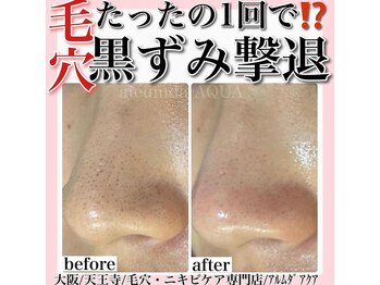 アルムダアクア 天王寺店(Aleumda AQUA)/毛穴エクストラクションプロ