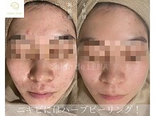 サロンドレナ 名駅店/ハーブピーリング サロンドレナ