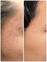 ラ メール ヴィーヴル/ニキビケア