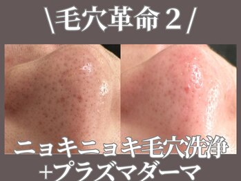 マヴィ 守口店(MavY.)/毛穴のお悩みすっきり！