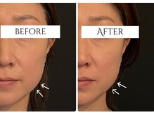 クク 赤坂 天神(99 KUKU)/【エラ張り】【リフトアップ】