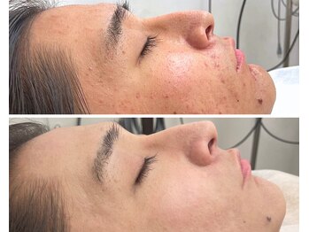 北原美顔/20代男性/ニキビケア