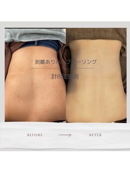 ライフサロン 別府(Life Salon)/背中ハーブトリートメント4