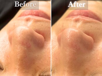 ボーンオム(Born Homme)/毛穴洗浄＋美容液導入：30代男性