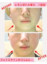 ユーフォリア(Euphoria)/レモンボトル導入フェイシャル★