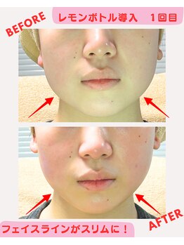 ユーフォリア(Euphoria)/レモンボトル導入フェイシャル★