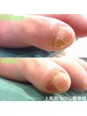フットケア　副爪ケア　施術例