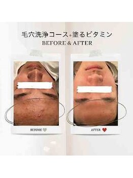 エクラ アン(eclat.un)/高校生男子：毛穴洗浄・ビタミン