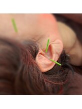 シンシンラボ 豪徳寺(SHINSHIN Lab)/耳鍼も効果的な施術法です♪