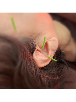 シンシンラボ 豪徳寺(SHINSHIN Lab)/耳鍼も効果的な施術法です♪