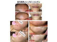 ジナ ビューティ(GINA BEAUTY)の雰囲気（お肌の悩みが改善されたビフォーアフター写真をご覧ください！）