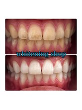 ホワイトニングショップ 大阪玉造店/Before&After美白ホワイトニング