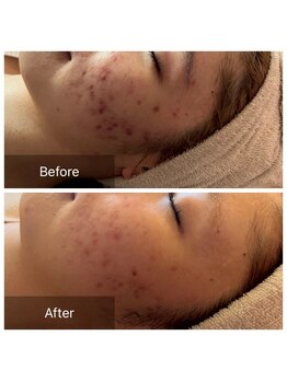 ケンビラク(Kenbiraku 健美楽)/ハイドラ　プラズマ殺菌　美容液