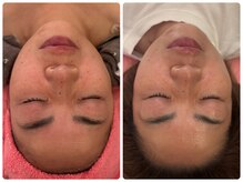 サロンドデュイ/1回施術/50代　EMSリフトアップ