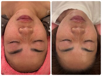 サロンドデュイ/1回施術/50代 EMSリフトアップ