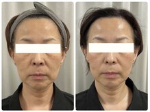 ビクシー(Bixie)/ラミピール