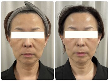 ビクシー(Bixie)/ラミピール