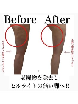 リンパケアサロン ジュビル(Jubil)の写真/短期集中痩身プログラム★【下半身痩身】細くて綺麗な美脚に！110分¥9990
