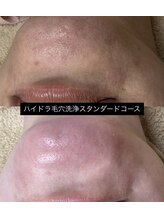ソアン(Soin)/毛穴洗浄