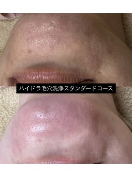 ソアン(Soin)/毛穴洗浄