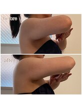 23ビューティー(23beauty)/これで二の腕スッキリ！