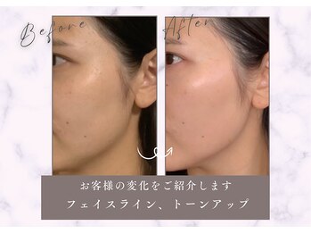 王子溝田橋整骨院 整体院の写真/40代からの肌を育てる、本格美容鍼で根本改善。初回体験で変化を実感してください！