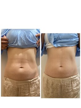 ルナート(Lunart)/美腸くびれモニター