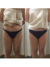 エン ボディアンドフェイシャル(En)/ハイパーナイフ下半身/痩身