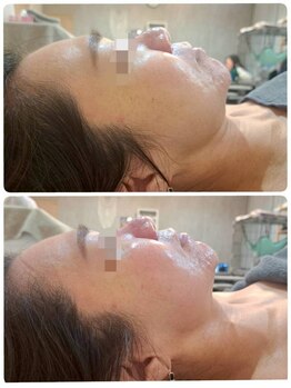 美ネージュ/フェイスラインのたるみに