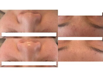 リンクアンドボーテ 大垣(Link&Beaute)/毛穴.くすみ