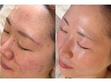 サロンムーン 赤坂(salon moon)/妊娠中の肌荒れもお任せください