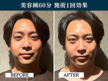 シンク(CINQ)/美容鍼灸60分メンズ小顔