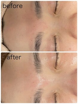 ハッチー(Hacchi)/陶肌トリートメント！