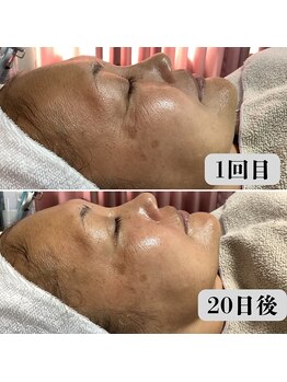 エステティックサロン S/NMNピーリングの効果