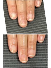 ルカロンネイル(Rukaron Nail)/トラブル爪