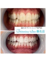 ホワイトニングサロン 三重県桑名店/ホワイトニング施術例