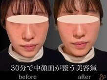 チョコバリ 新宿店(chocobari)/小顔×リフトアップ(美容鍼)20代