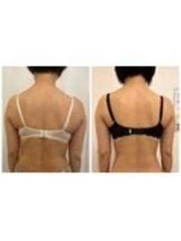 美人バスト 南森町店/バストアップ ◇症例◇