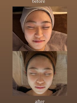 サロンリンセ(Rinse)/セラピール・ビフォーアフター☆