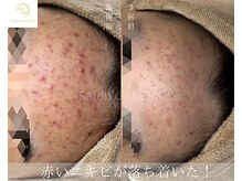 サロンドレナ 名駅店/ハーブピーリング サロンドレナ