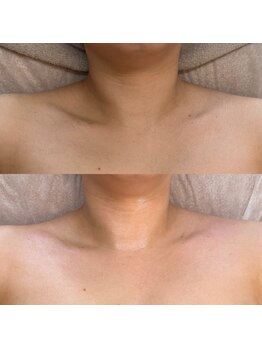 エルピス(ELPIS)/デコルテのWax脱毛(既存限定)