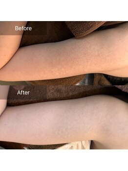 ビビ(VIVI)/二の腕の毛孔性苔癬にも！