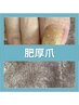 【肥厚爪でお悩みの方専用】足の爪がうまくカットできない方に◎¥8000