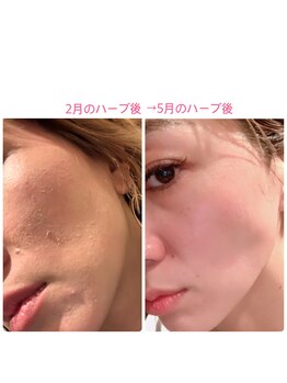 エステティックシトラス(esthetic CITRUS)/TIPハーブピーリング